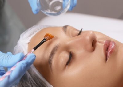 Chemical Peel