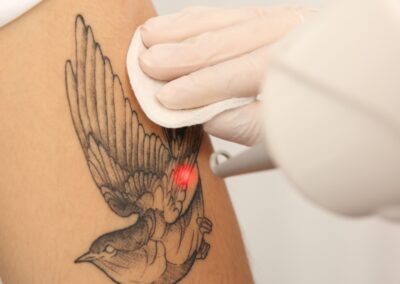 Tattoo Removal